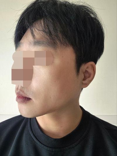 이마거상 6주차, 이마주름 90프로 사라지고 눈썹도 올라갔어요 사진 5 — 아바성형외과 안면거상 후기