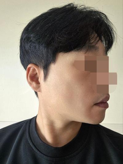 이마거상 6주차, 이마주름 90프로 사라지고 눈썹도 올라갔어요 사진 6 — 아바성형외과 안면거상 후기