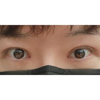 쌍꺼풀 눈매교정 앞트임 1개월, 눈 뜨기 훨씬 편해졌어요 — 아바성형외과 환자 후기 사진