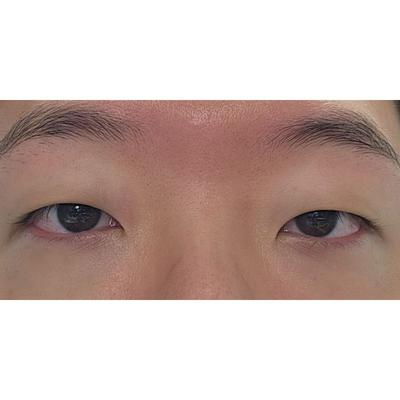 쌍꺼풀 눈매교정 앞트임 1개월, 눈 뜨기 훨씬 편해졌어요 사진 2 — 아바성형외과 쌍꺼풀·눈성형 후기