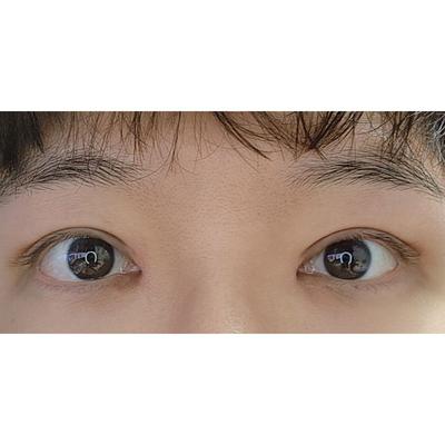 눈 수술 2주차, 원하던 눈매 되어가고 뜨는 것도 편해요 — 아바성형외과 환자 후기 사진