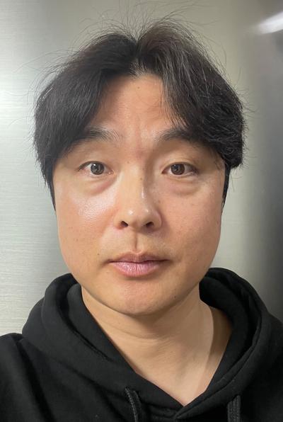 친구 소개로 받은 시술, 3일차 붓기 관리 중이에요 사진 3 — 아바성형외과 기타 후기