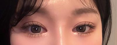 수술 7주차, 흉 하나 없고 보는 사람마다 예쁘다고 해요 — 아바성형외과 환자 후기 사진