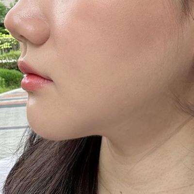 턱밑 수술 후 없던 턱선 나오고 얼굴이 갸름해졌어요 — 아바성형외과 환자 후기 사진