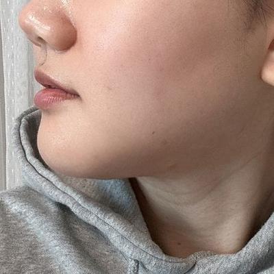 턱밑 수술 후 없던 턱선 나오고 얼굴이 갸름해졌어요 사진 2 — 아바성형외과 기타 후기
