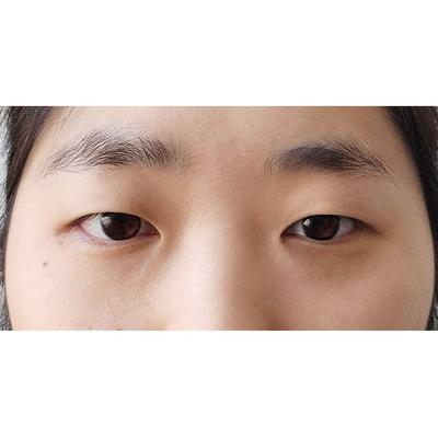 안검하수 쌍꺼풀 2주차, 눈 뜨는 힘이 확 좋아졌어요 사진 2 — 아바성형외과 쌍꺼풀·눈성형 후기