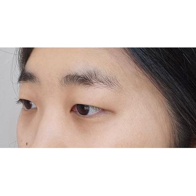 안검하수 쌍꺼풀 2주차, 눈 뜨는 힘이 확 좋아졌어요 사진 3 — 아바성형외과 쌍꺼풀·눈성형 후기