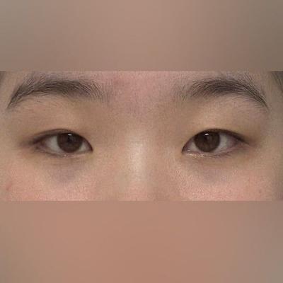 쌍꺼풀 4주차, 인아웃라인으로 어중간했던 눈 바뀌었어요 사진 2 — 아바성형외과 쌍꺼풀·눈성형 후기