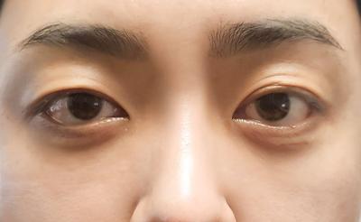 눈밑지방재배치+코수술 8주차 경과 후기 남겨요 — 아바성형외과 환자 후기 사진