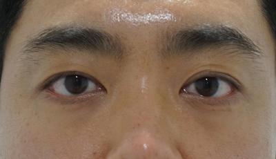 눈밑지방재배치+코수술 8주차 경과 후기 남겨요 사진 2 — 아바성형외과 눈밑지방재배치 후기