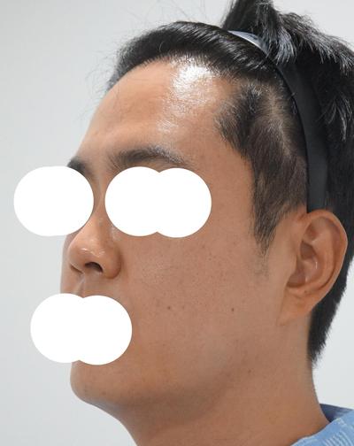 눈밑지방재배치+코수술 8주차 경과 후기 남겨요 사진 4 — 아바성형외과 눈밑지방재배치 후기