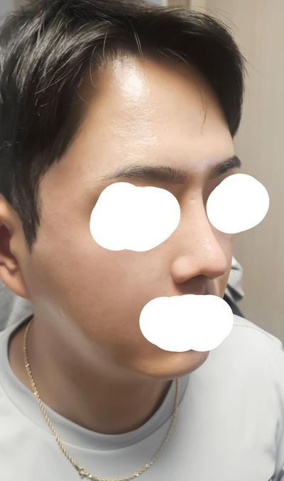 눈밑지방재배치+코수술 8주차 경과 후기 남겨요 사진 5 — 아바성형외과 눈밑지방재배치 후기
