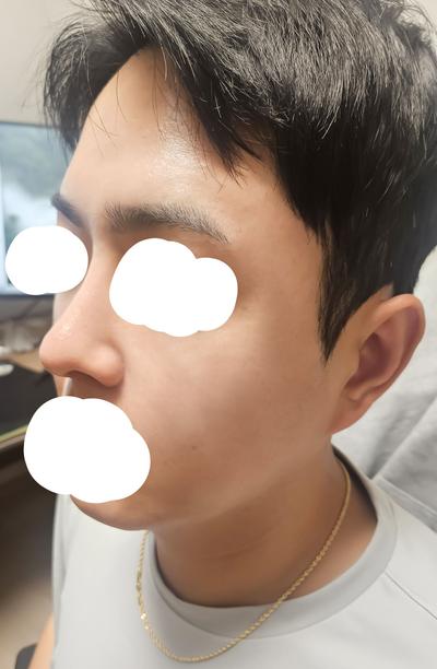 눈밑지방재배치+코수술 8주차 경과 후기 남겨요 사진 6 — 아바성형외과 눈밑지방재배치 후기