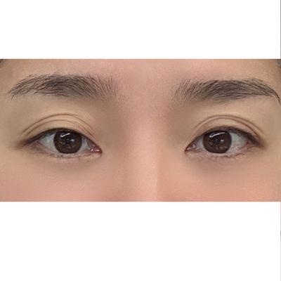 절개쌍수 눈매교정 한달차, 원하던 눈 그대로 나왔어요 — 아바성형외과 환자 후기 사진