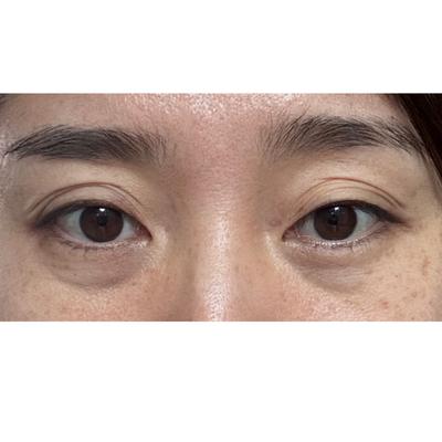 절개쌍수 눈매교정 한달차, 원하던 눈 그대로 나왔어요 사진 2 — 아바성형외과 쌍꺼풀·눈성형 후기