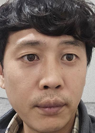 하안검 10주차, 눈 커졌다는 말에 수술하길 잘했다 싶어요 — 아바성형외과 환자 후기 사진