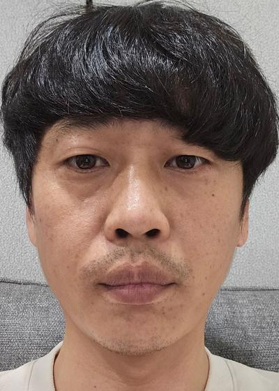 하안검 10주차, 눈 커졌다는 말에 수술하길 잘했다 싶어요 사진 2 — 아바성형외과 하안검 후기
