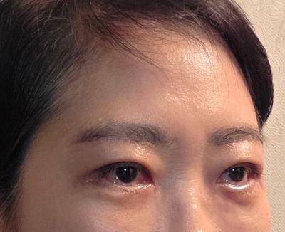 이마거상 4주차, 받은 수술 중에 만족도가 제일 커요 — 아바성형외과 환자 후기 사진