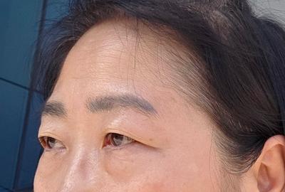 이마거상 4주차, 받은 수술 중에 만족도가 제일 커요 사진 2 — 아바성형외과 안면거상 후기