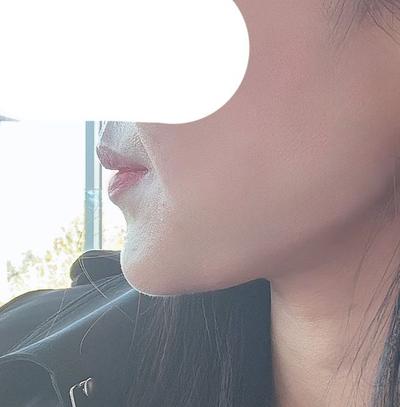 기타 환자 후기 — 나 이중턱 때문에 솔직히 얼... (3)