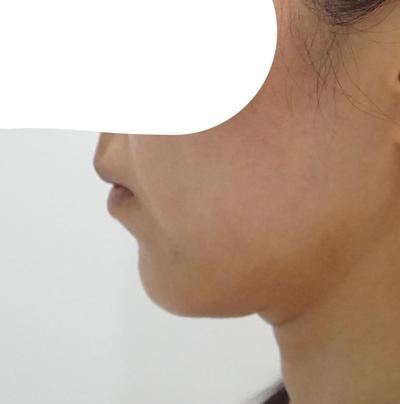 이중턱 근육묶기만 했는데 턱선이 완전 날렵해졌어요 사진 2 — 아바성형외과 이중턱·윤곽 후기