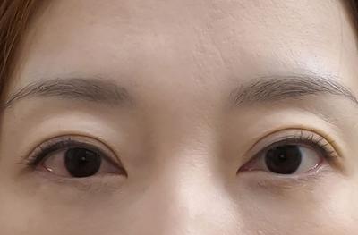 눈밑지방재배치 4주차, 칙칙했던 눈밑 확 좋아졌어요 — 아바성형외과 환자 후기 사진