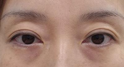 눈밑지방재배치 4주차, 칙칙했던 눈밑 확 좋아졌어요 사진 2 — 아바성형외과 눈밑지방재배치 후기