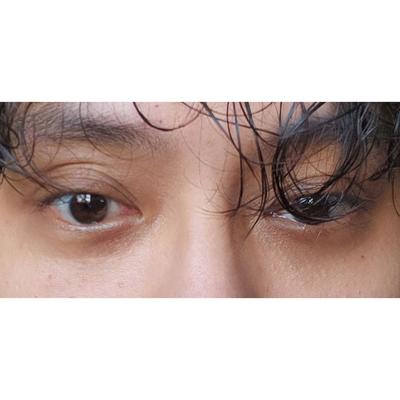 눈밑 수술 4주 경과, 피곤해 보이던 눈이 확 달라졌어요 — 아바성형외과 환자 후기 사진