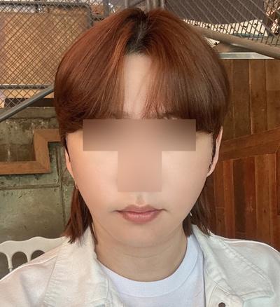스마스거상 3주차, 광대축소 같이 했는데 회복 순조로워요 — 아바성형외과 환자 후기 사진