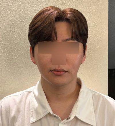 스마스거상 3주차, 광대축소 같이 했는데 회복 순조로워요 사진 2 — 아바성형외과 안면거상 후기