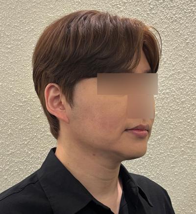 스마스거상 3주차, 광대축소 같이 했는데 회복 순조로워요 사진 4 — 아바성형외과 안면거상 후기