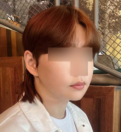 스마스거상 3주차, 광대축소 같이 했는데 회복 순조로워요 사진 5 — 아바성형외과 안면거상 후기