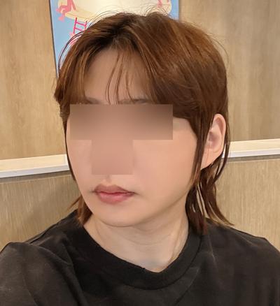 스마스거상 3주차, 광대축소 같이 했는데 회복 순조로워요 사진 6 — 아바성형외과 안면거상 후기
