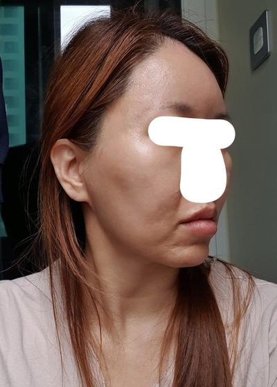 안면거상 아큐 7주차, 심부볼 팔자 많이 개선됐어요 사진 3 — 아바성형외과 안면거상 후기