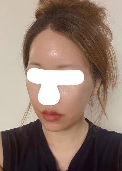 안면거상 아큐 7주차, 심부볼 팔자 많이 개선됐어요 사진 5 — 아바성형외과 안면거상 후기