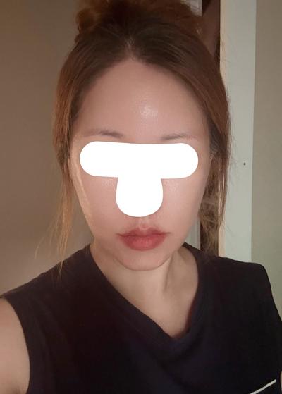 안면거상 아큐 7주차, 심부볼 팔자 많이 개선됐어요 사진 7 — 아바성형외과 안면거상 후기