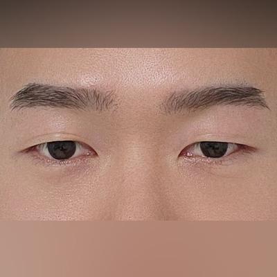 눈밑지방재배치, 짝짝이 대칭 맞고 눈가가 확 환해졌어요 — 아바성형외과 환자 후기 사진