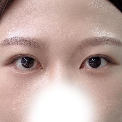 눈밑 수술 후기, 만족하는데 한쪽 구축 회복 기다려요 — 아바성형외과 환자 후기 사진