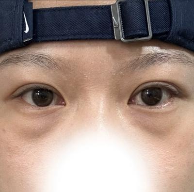 눈밑 수술 후기, 만족하는데 한쪽 구축 회복 기다려요 사진 2 — 아바성형외과 눈밑지방재배치 후기