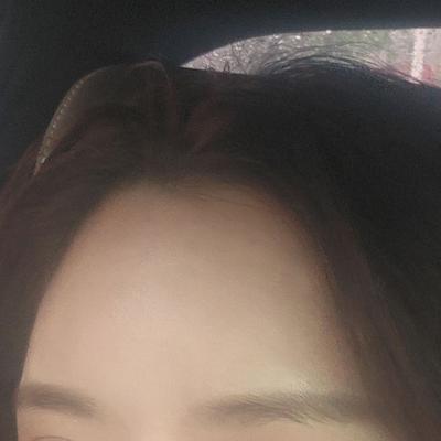 이마 지방이식 8주차, 이마 라인 자연스럽게 살아났어요 사진 4 — 아바성형외과 이마거상 후기