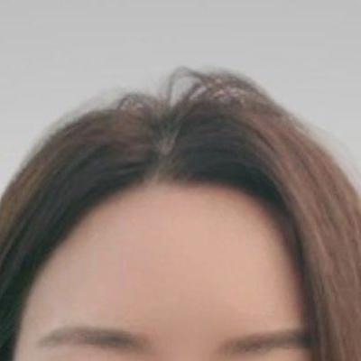 이마지방이식 4주차, 인상 부드러워졌다는 말 많이 들어요 — 아바성형외과 환자 후기 사진