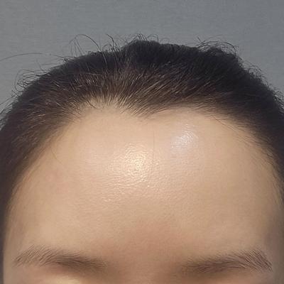 이마지방이식 4주차, 인상 부드러워졌다는 말 많이 들어요 사진 3 — 아바성형외과 이마거상 후기