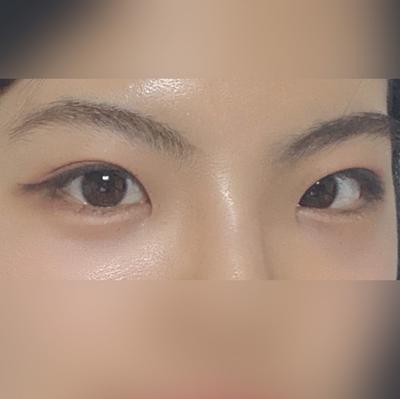 눈밑지방재배치 2주차, 또렷해진 눈매에 거울만 봐요 — 아바성형외과 환자 후기 사진