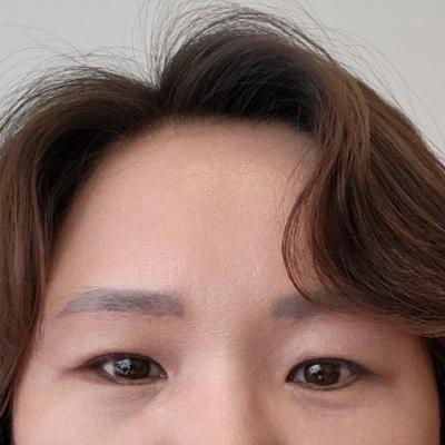 안면거상 환자 후기 — 눈두덩이살 쳐짐으로 속쌍이 ... (308)