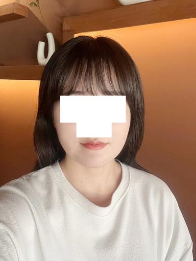 턱 아큐스컬프 9주차, 옆에서 봐도 이중턱이 확 줄었어요 — 아바성형외과 환자 후기 사진