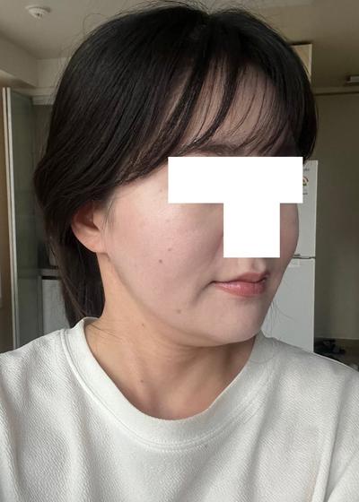 턱 아큐스컬프 9주차, 옆에서 봐도 이중턱이 확 줄었어요 사진 3 — 아바성형외과 이중턱·윤곽 후기