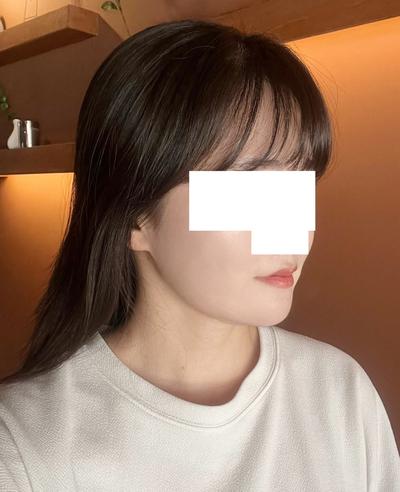 턱 아큐스컬프 9주차, 옆에서 봐도 이중턱이 확 줄었어요 사진 5 — 아바성형외과 이중턱·윤곽 후기