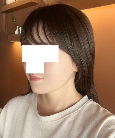 턱 아큐스컬프 9주차, 옆에서 봐도 이중턱이 확 줄었어요 사진 6 — 아바성형외과 이중턱·윤곽 후기