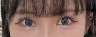 쌍꺼풀 절개 재수술 9주차, 눈 비대칭 많이 개선됐어요 — 아바성형외과 환자 후기 사진