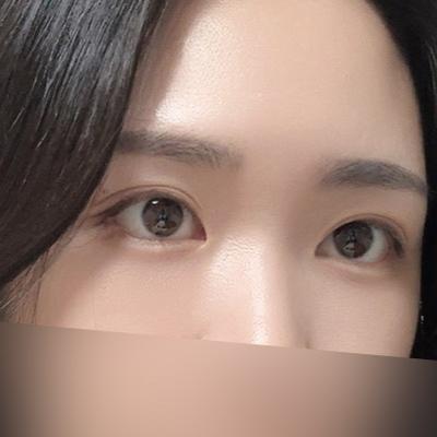 눈밑지방재배치 6주차, 눈밑 꺼짐 신경 하나도 안 쓰여요 — 아바성형외과 환자 후기 사진
